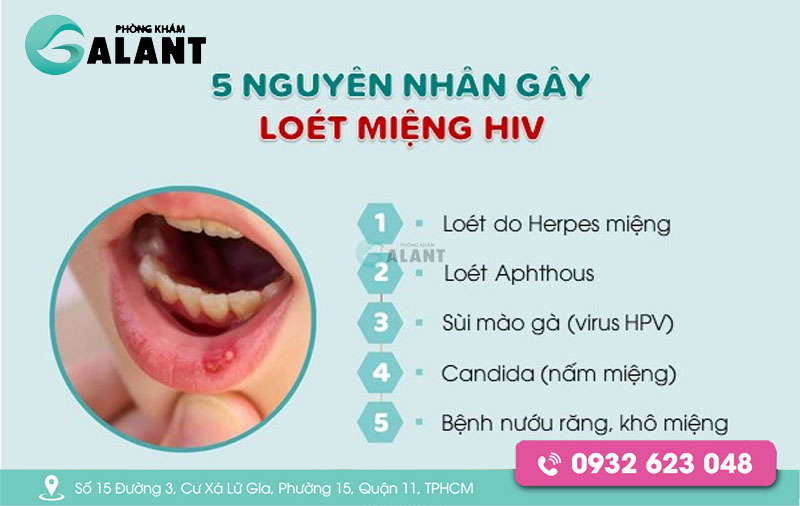 Viêm Loét Miệng Hiv