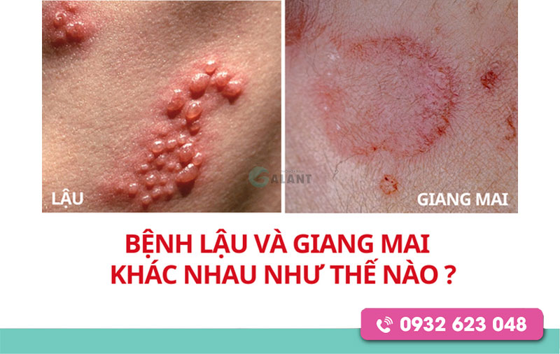 Biểu hiện của bệnh giang mai và lậu