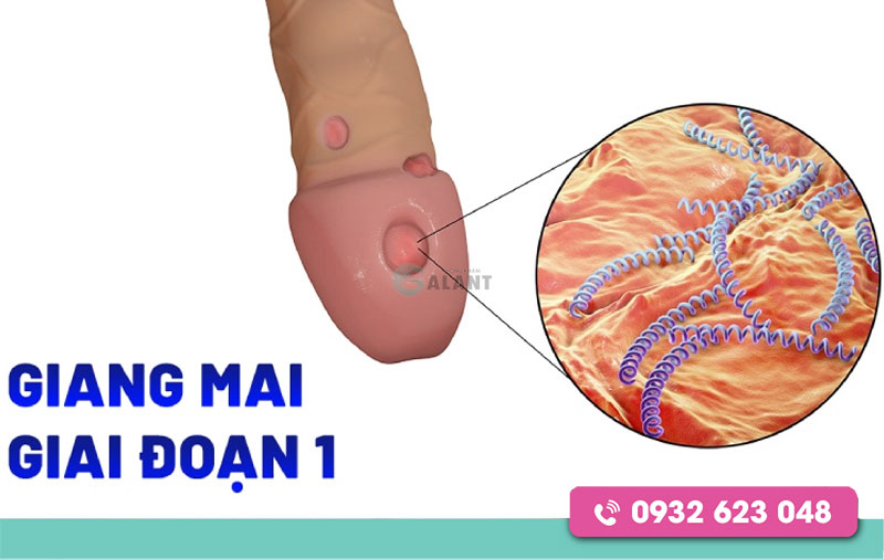 Giang mai giai đoạn đầu ở nam giới