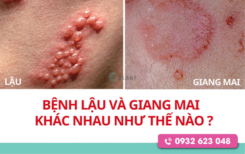 dấu hiệu của giang mai và lậu